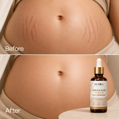 Stretch Mark Serum